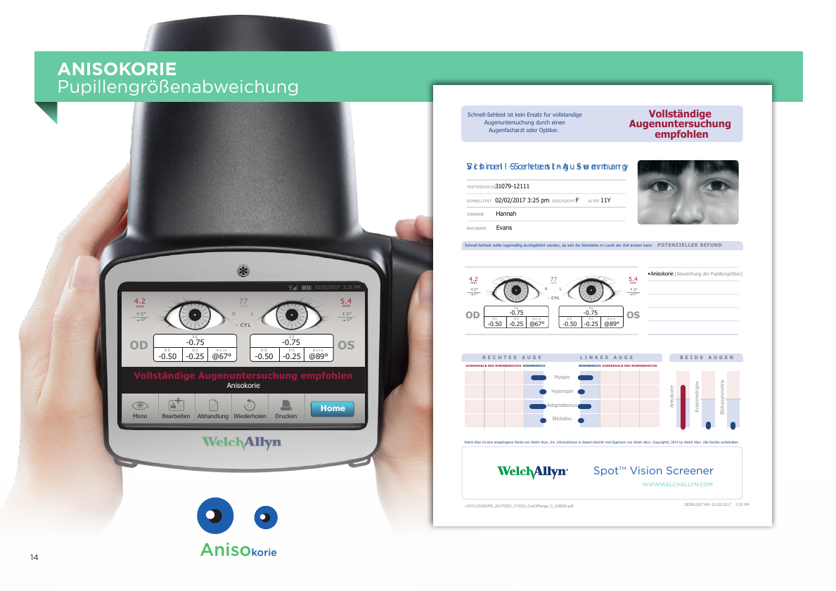 Spot™ Vision Screener Etikettendruck Anisokorie Pupillengrößenabweichung